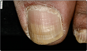 Toe at baseline