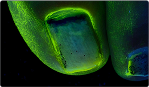 UV light after application 2