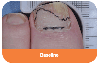 Diabetes toe at baseline