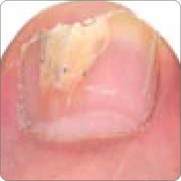 Toenail